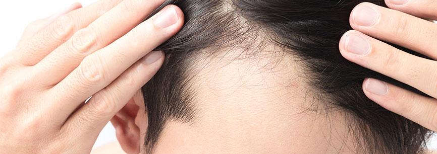 4 мифа о пересадке волос